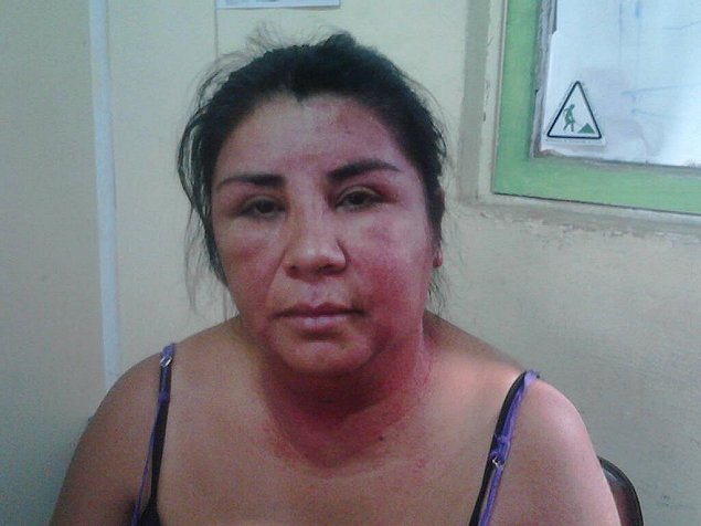 [Chile] Denuncian a Carabinero de Temuco por utilizar químicos que dejaron con serias quemadura a mujer Mapuche